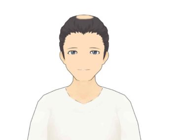 男性型脱毛症（ＡＧＡ）